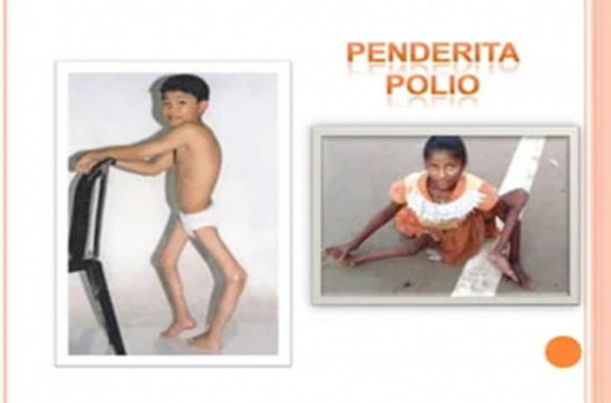 Penyakit Polio dan Pencegahannya